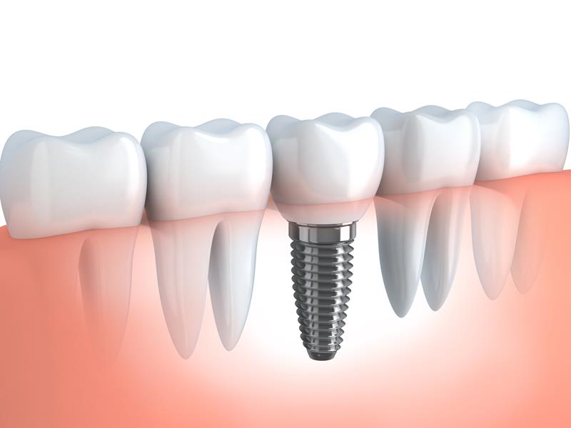 Dental Implants Evanston, IL  